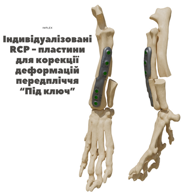 RCP - пластина для корекції деформацій передпліччя S imp-4-1 фото